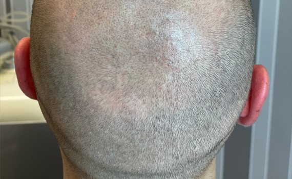 trychopigmentacja skóry głowy Zielona Góra
